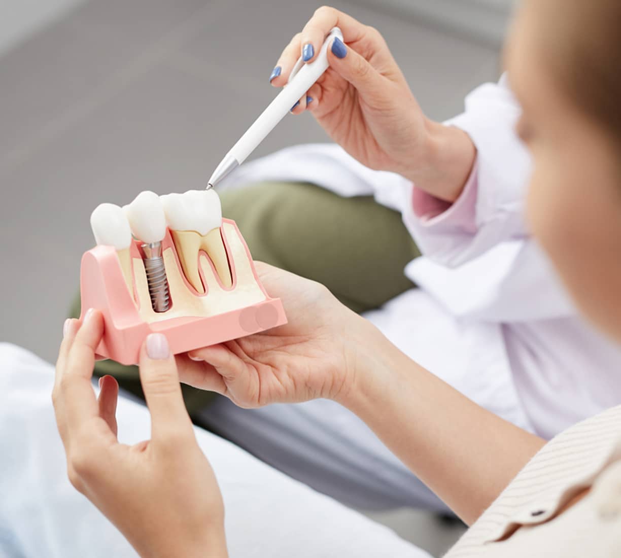 Dental Implants