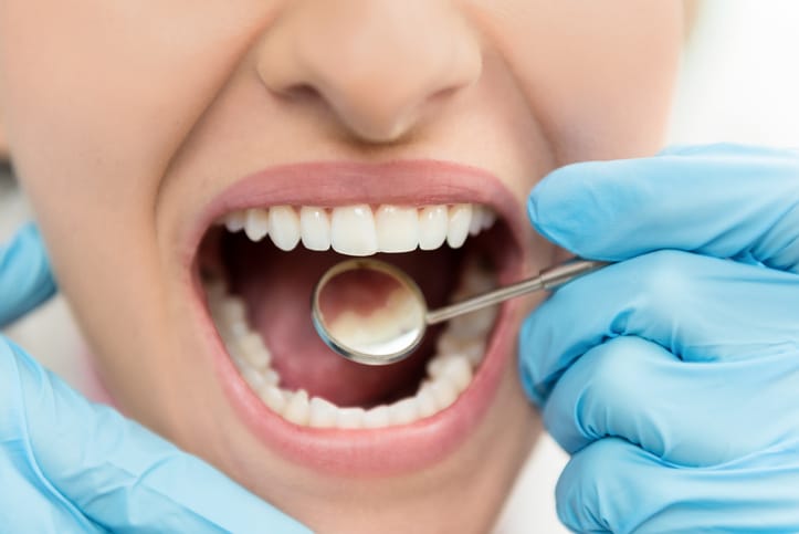 Oral Cancer Screening